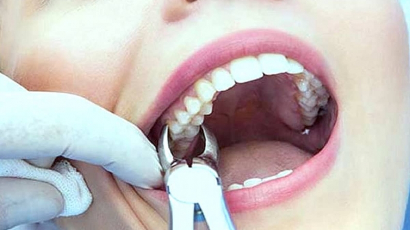كيفية التخلص من الم الاسنان بعد الخلع الجواب