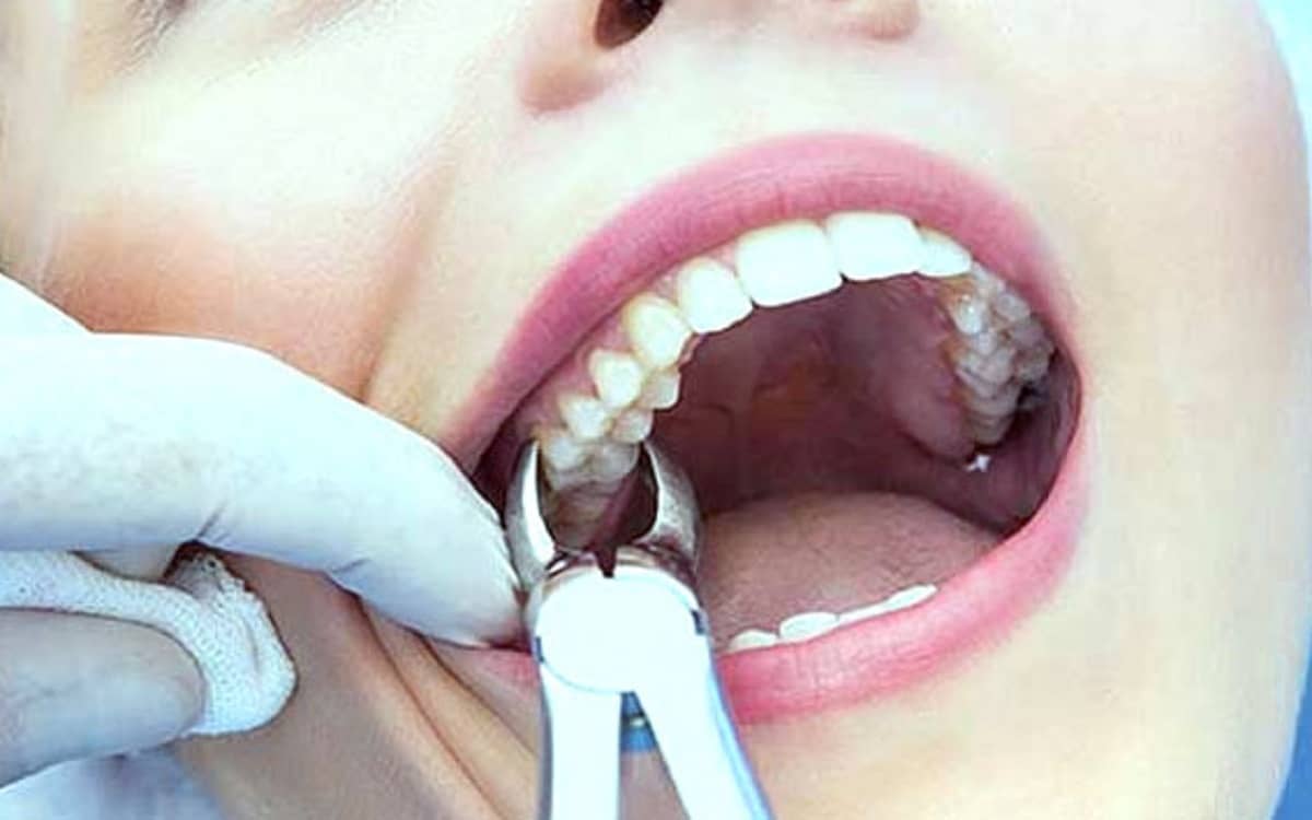 صورة كيفية التخلص من الم الاسنان بعد الخلع