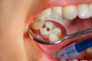 كيفية التخلص من تسوس الاسنان