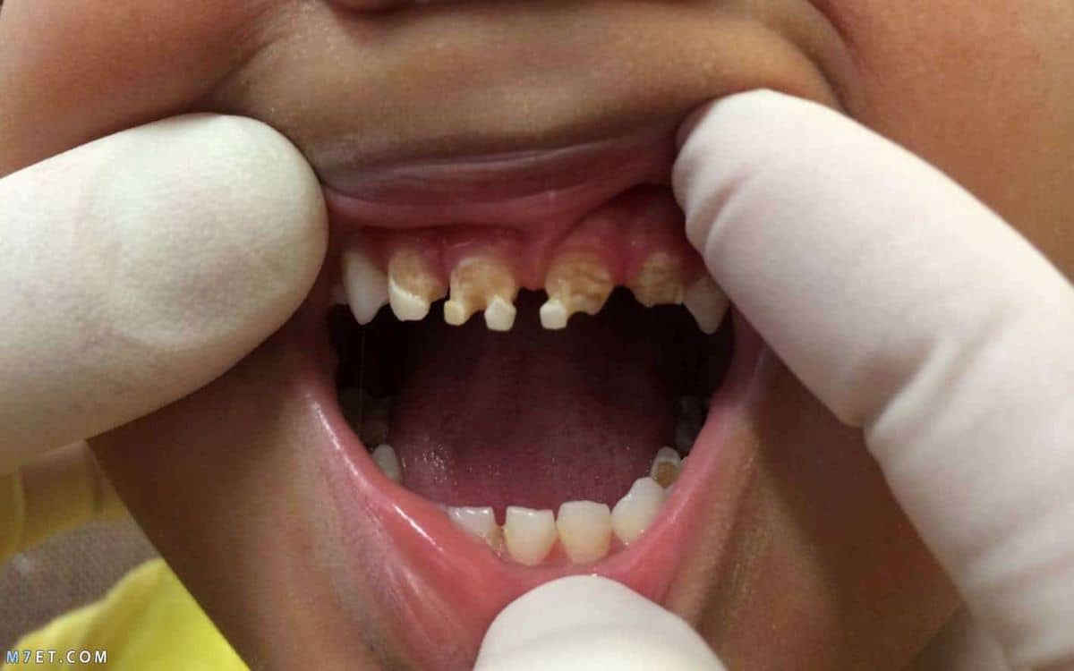 كيفية التخلص من تسوس الاسنان