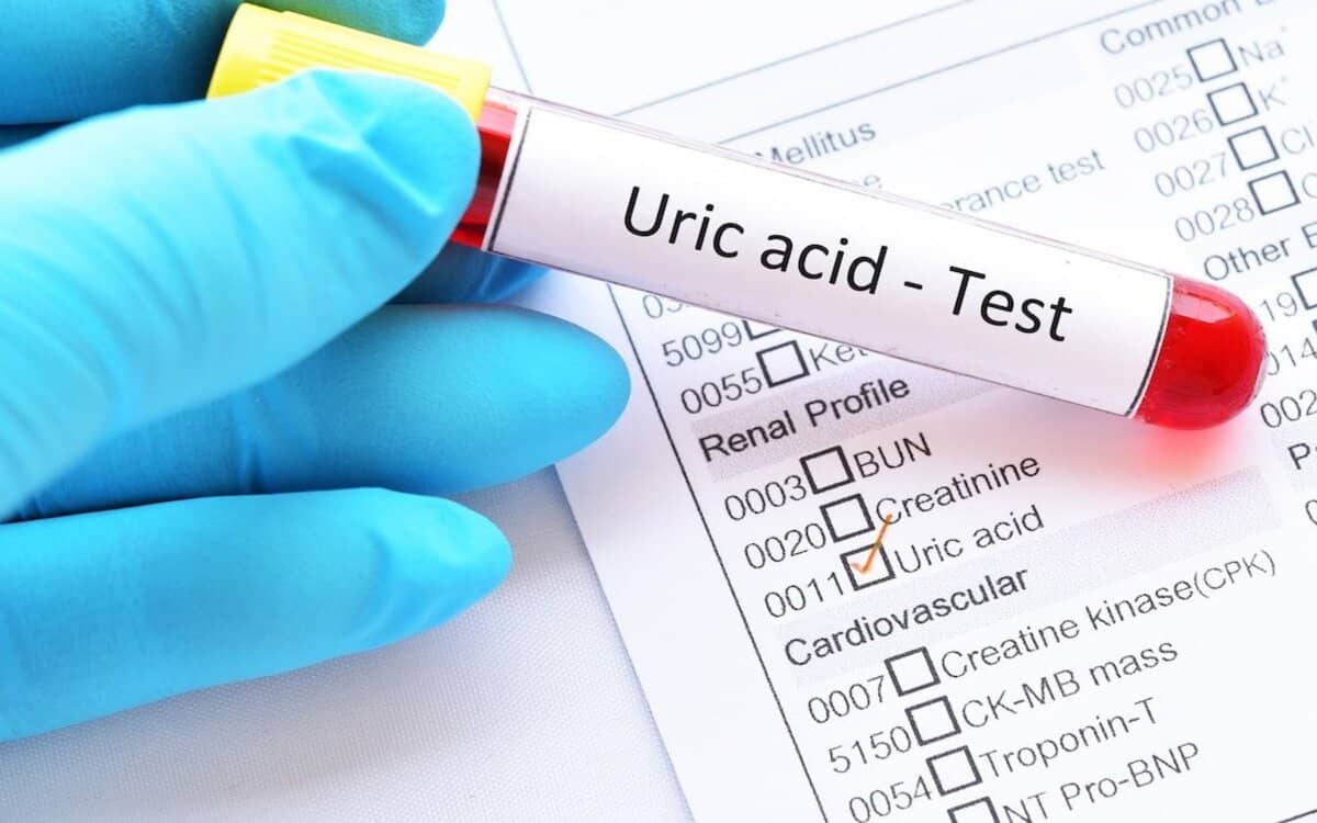 صورة سعر تحليل uric acid