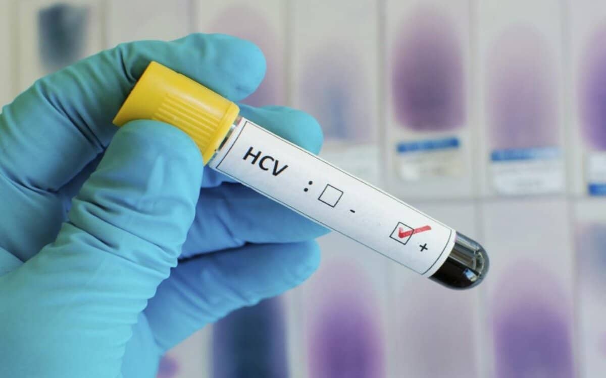 سعر تحليل التهاب الكبد الوبائي  hcv ab