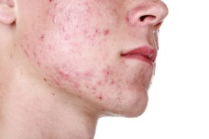 اسماء ادوية لعلاج اثار حب الشباب اسماء ادوية لعلاج اثار حب الشباب