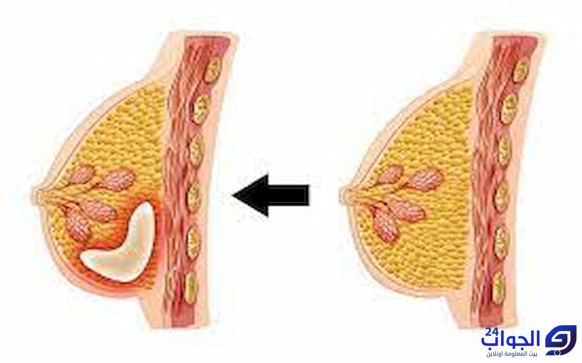 صورة تجربتي مع تكيسات الثدي