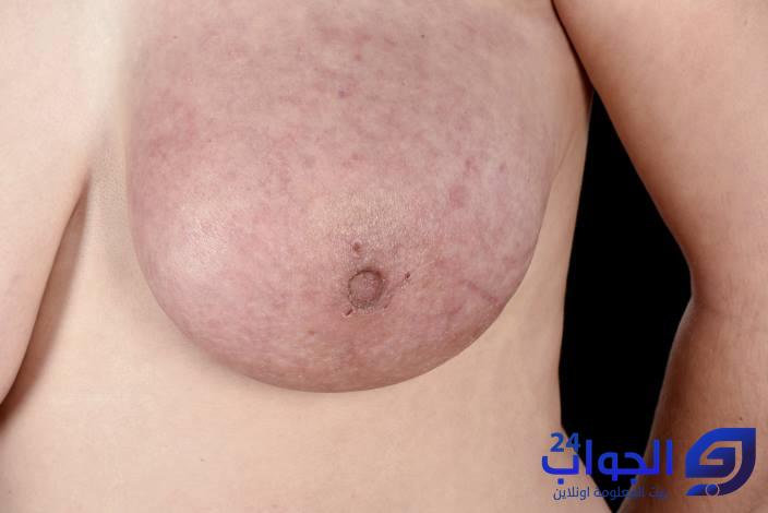 سرطان الثدي الالتهابي بالصور
